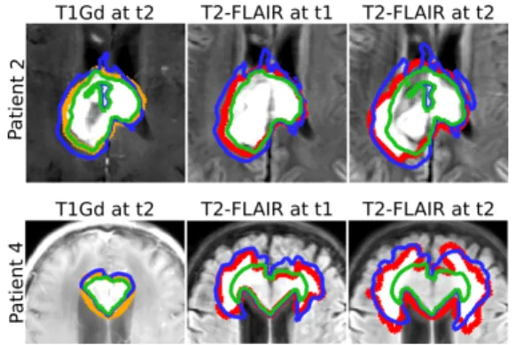 Figure 10: Maximum a Posteriori fit for Patient 1 (Top) and Patient 4 (Bottom). For each patient: (Left) The proliferative rim is outlined in orange on the T1Gd MRI at two different time points; (Middle Left) The edema is outlined in red on the T2-FLAIR MR