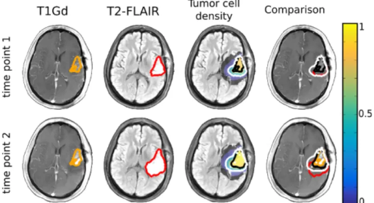 Figure 1: (Left) The proliferative rim is outlined in orange on the T1Gd MRI at two different time points; (Middle Left) The edema is outlined in red on the T2-FLAIR MRI at two different time points.
