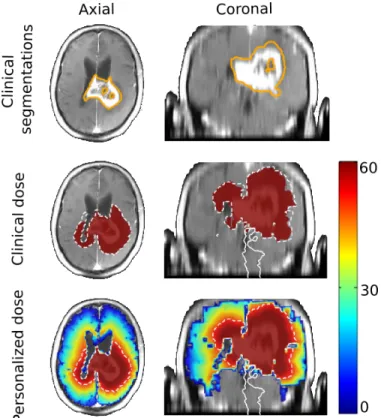 Figure 1. The clinical segmentation of the T1Gd abnormality (Top, orange line) is used to define the clinical target volume (CTV, white dashed line) as a 2 cm expansion of the segmentation