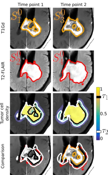 Figure 3. First time point on the left, second time point on the right. (Top) The proliferative rim is outlined in orange on the T1Gd MRI