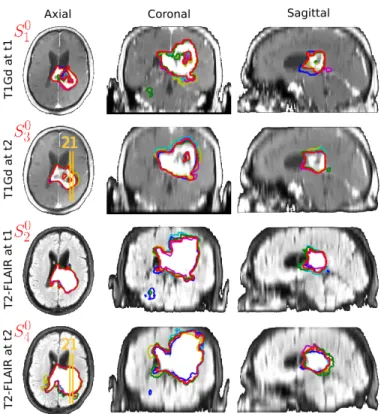 Figure 4. From top to bottom: segmentation samples for the T1Gd at the first and second time points, and for the T2-FLAIR at the first and second time points