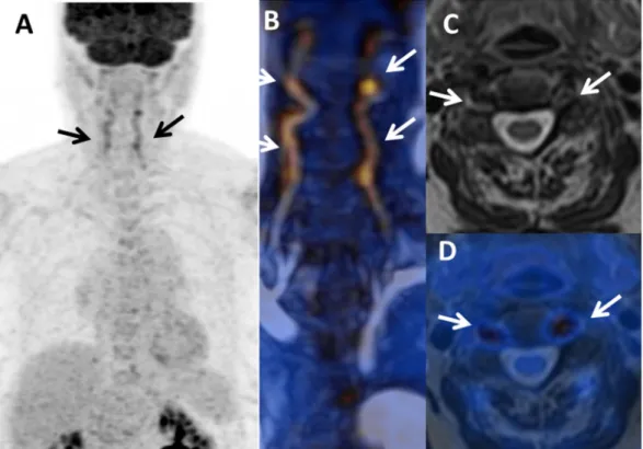 Figure 1.  PET/MRI used for the initial diagnosis of giant cell arteritis (GCA) in a female with temporal  headaches and acute-phase reactants without any vascular signs or arthralgia