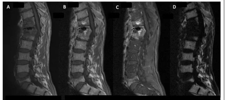 Fig. 1 Spinal MRI, sagittal section: Hyperintensity, T11-T12-L1 vertebrae, para-vertebral soft tissue, and T12-L1 disc consistent with infectious spondylodiscitis
