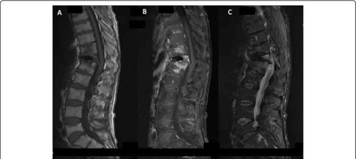 Fig. 2 Spinal MRI, sagittal section 1 year later: A decrease in signal was observed. a T1-weighted; b T1-weighted with contrast agent; c STIR sequence