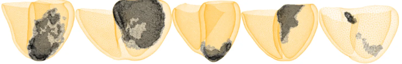 Fig. 3: Personalized heart meshes for our five patients depicting healthy myocardium (yellow), scar (black) and border zone (grey) tissues derived from DE-MRI segmentations.