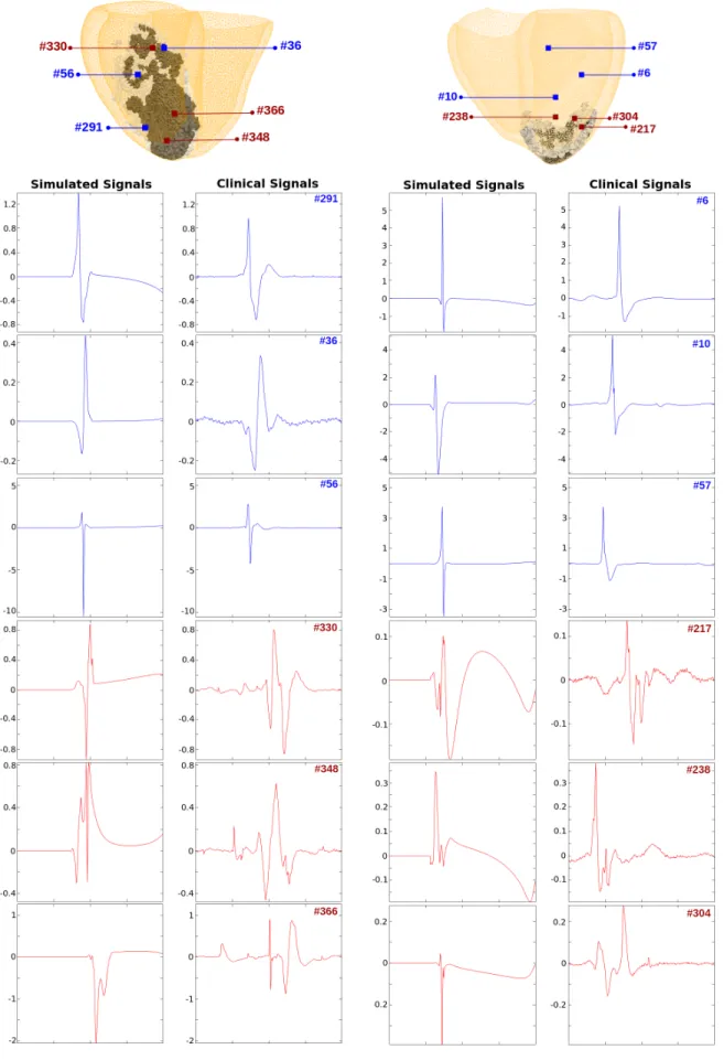 Fig. 6: Simulated and clinical normal (blue) and abnormal (red) bipolar EGM with electrode locations.