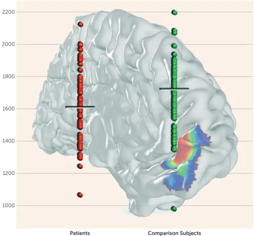 FIGURE 2. Region-Based Gray Matter Volume Analysis in Major Depressive Disorder Using Cytoarchitectonic Maps of the Human Frontal Pole a