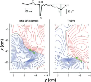 FIG. 4. 共 Color 兲 Isocontours of the normal component of the magnetic field during the initial QR-segment and T-wave; blue and red indicate field in and out, respectively, of the chest of the subject