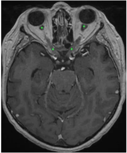 Figure 4: Approximate position of the optic nerve landmarks (displayed on the same axial slice) found by the system on a test example