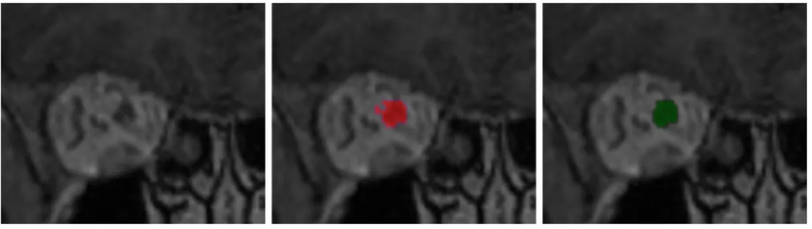 Figure 6: Use of mathematical morphology for reduction of false positives. Left: a coronal patch centered on an optic nerve