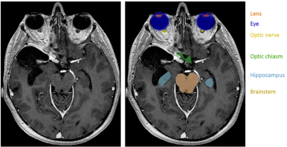 Figure 1: Segmentation of organs at risk in radiotherapy planning. Left: T1-weighted MRI acquired after injection of a gadolinium-based contrast agent