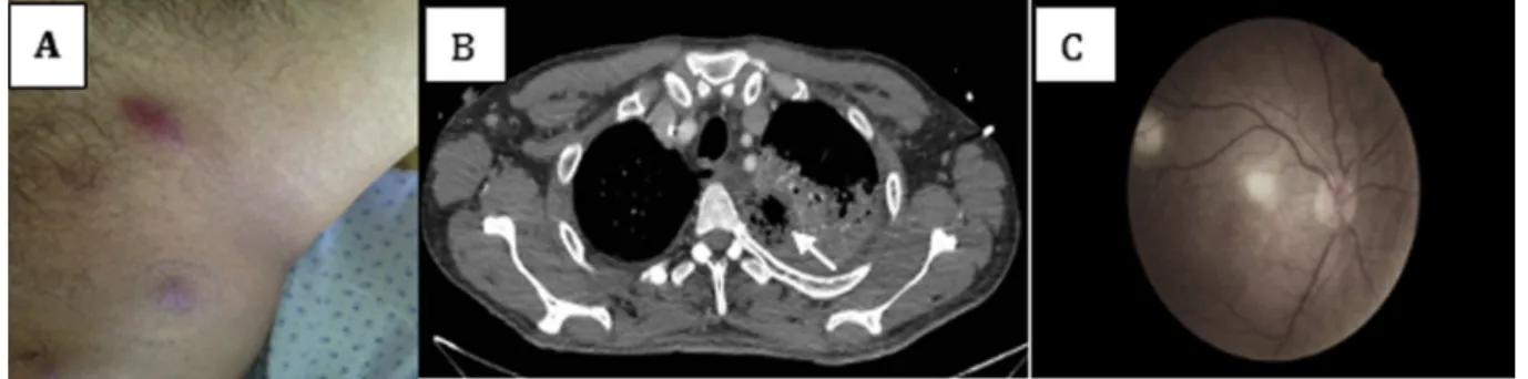 Figure 1. Multiple necrotizing organ damages due to P. aeruginosa. 1A. Erythematous nodules of the left side of the pelvis