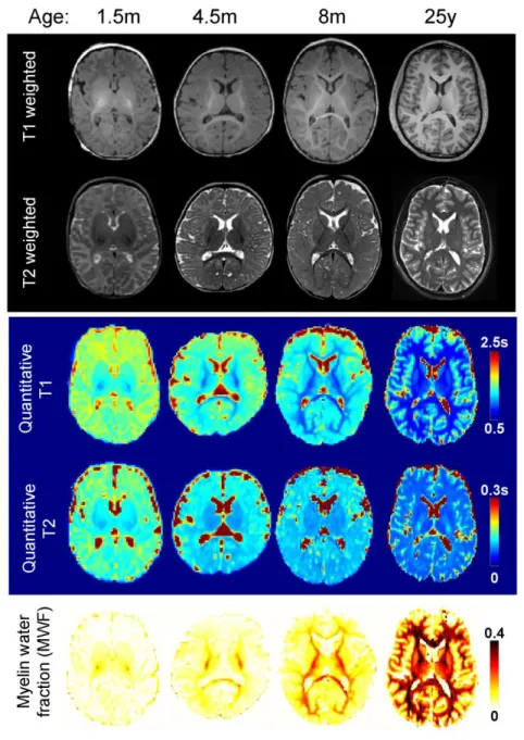 Figure  3:  Anatomical  images  of  the  developing  brain.  From  top  to  bottom,  T1  weighted,  T2  weighted  images,  quantitative  maps  of  T1,  T2  relaxation  times  (in  seconds)  and  myelin  water  fraction (MWF) of representative subjects at d