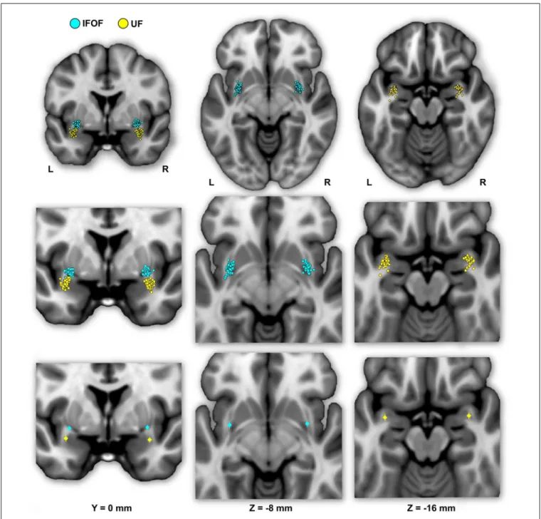 Figure 4 shows the individual and mean center of mass locations of the IFOF and UF stems as points projected on a single-subject MNI T1 brain