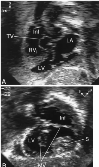 Figure 1. Straddling mitral valve in a patient with double outlet right ventricle and {S,D,D} segmental anatomy
