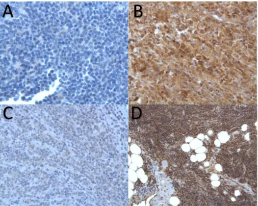 Fig 1. NS3 immunostaining in HCV associated non-Hodgkin ’ s lymphomas. A: Negative staining of a marginal zone lymphoma (MZL)