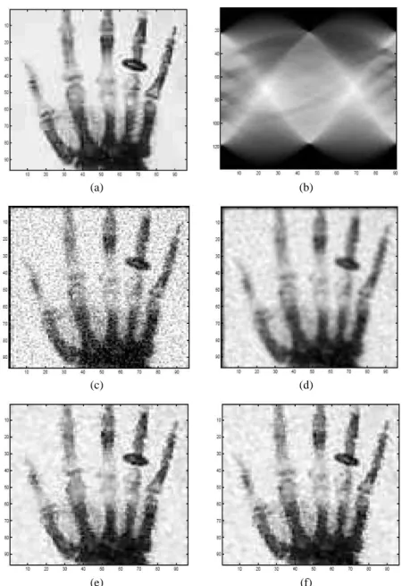 Figure 7. Reconstruction of a hand image: (a) original image; (b) noisy sinogram (SNR=24); reconstructed images by: (c) FBP (PSNR=14.34, SSIM=0.39); (d) FBP +  Ham-ming filter (PSNR=16.77, SSIM=0.56); (e) topological gradient + TV norm (PSNR=24.32, SSIM=0.