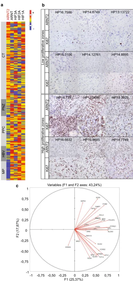 Fig. 5    ARNT2 is expressed in  patients’ glioblastoma and is  associated with a tumorigenic/
