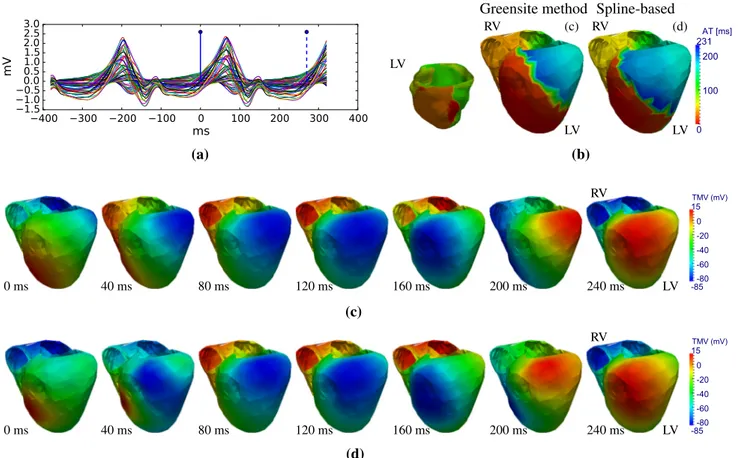 Fig. 2 Sustained monomorphic VT: evaluation of ECG imaging against simultaneous non-contact mapping (LV/RV: left/right  ventri-cle)