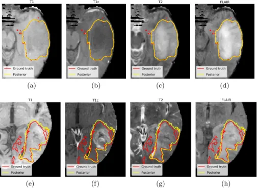 Fig. 3: Posterior and ground truth segmentations shown in the 4 modalities (T1, T1c, T2 and FLAIR) for 2 cases presented in Fig