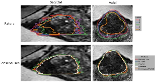 Fig. 2. Consensuses given by different methods on human raters’ prostate delineations.
