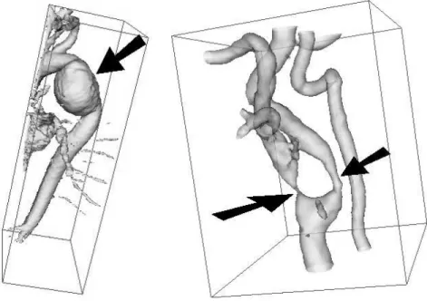 Fig. 1. Shaded-surface display of contrast-enhanced MRA images: aorta arch with an aneurysm (left), carotid artery with severe stenoses (right)