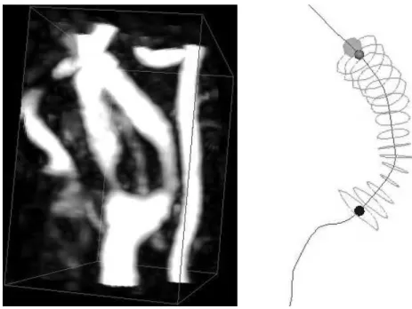 Fig. 2. Maximum intensity projection (left) of the stenosed carotid arteries from Fig