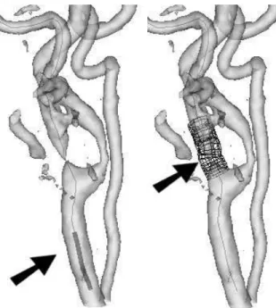 Fig. 3. Simulation of stent insertion and deployment using a simplified geometrical model: a contracted stent (left) is placed along a catheter and guided until the delivery location, once expanded (right) the stent becomes shorter