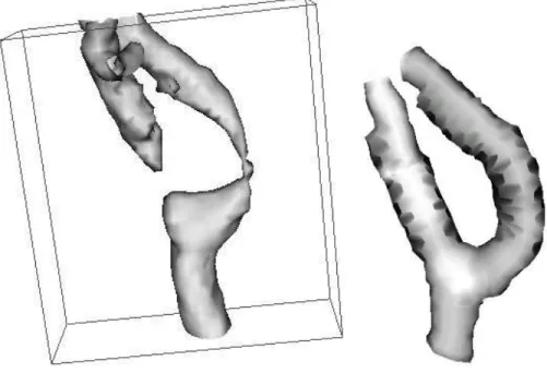 Fig. 6. Simulation of stent/vessel-wall interaction in real stenosed carotid arteries from (Fig