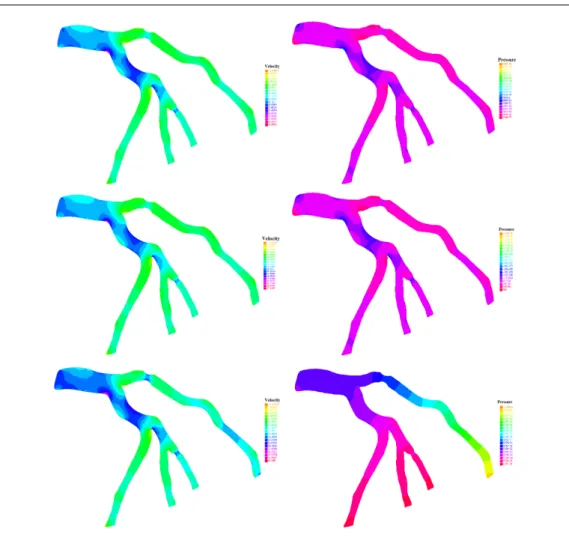 Fig. 8 From top to bottom: Velocity and pressure fields at t = 0.59s (peak diastole) using Windkessel model, free pressure outlet boundary conditions and mixed outlet boundary conditions (as defined in the paragraph above) respectively.