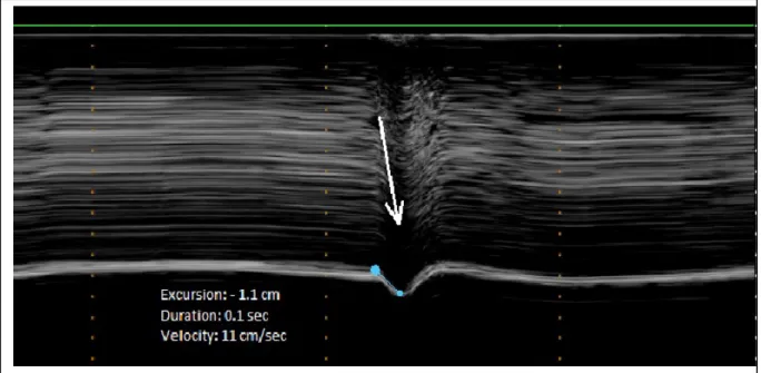 Figure 2:  M-mode ultrasonography of a paralyzed hemidiaphragm during voluntary sniffing  showing a paradoxical motion (arrow)
