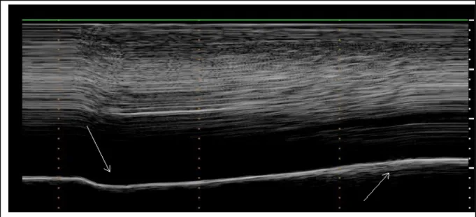 Figure 3: During deep breathing, a biphasic movement was observed on M-mode  ultrasonography with an initial paradoxical movement (left arrow) and a terminal caudal  displacement (right arrow)