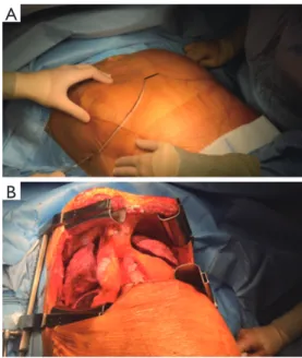 Figure 1 Anesthesiologic preparation. 1, double-lumen tube; 2,  central venous catheter; 3, Swan-Ganz probe; 4, invasive blood  pressure/arterial catheter.