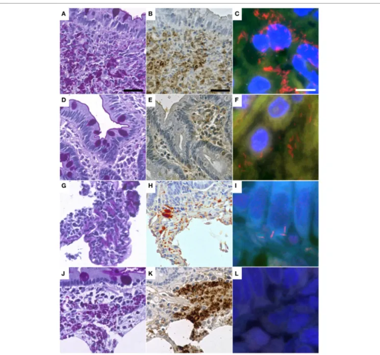 FigUre 1 | Representative cases of Whipple’s disease with periodic acid-Schiff diastase staining (a,D,g,J) show accumulated macrophages intensely positive   in periodic acid–Schiff diastase staining and with positive reaction in immunohistochemistry with a