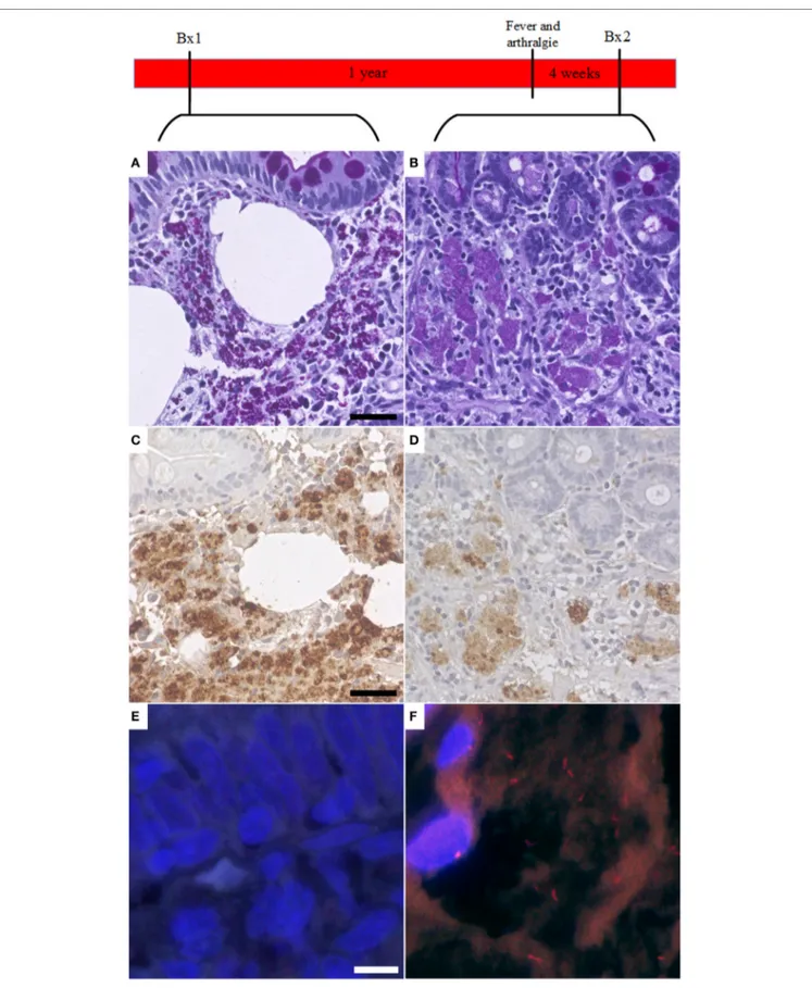 FigUre 3 | Fluorescent in situ hybridization (FISH) of Tropheryma whipplei (T. whipplei) may be a marker of disease recurrence