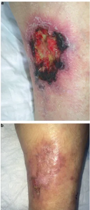 Figure 3. a : calciphylaxie ayant simulé une angiodermite nécrotique chez une femme dialysée hypertendue ; b : même ulcère après greffe de peau mince et 6 semaines de traitement par thiosulfate (coll