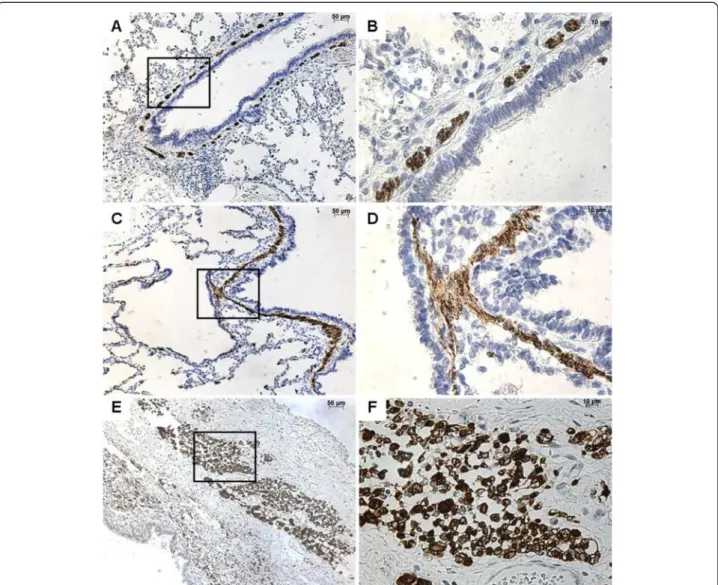 Figure 5 Immunohistochemistry with desmin. From left to right, original magnification x 10 (A, C, E), x 40 (B, D, F)