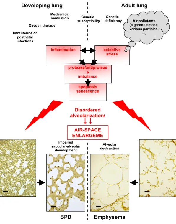 Figure  2.  Integration  of  pathogenic  mechanisms  in  bronchopulmonary  dysplasia  (BPD)  and  emphysema