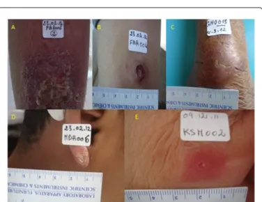 Figure  2 :   Clinical  spectrum  of  the  cutaneous  leishmaniases.  The disease  encompasses  a  range  of  clinical  symptoms,  including infiltrated  plaque,  ulcero-crusted  lesions  of  the  leg