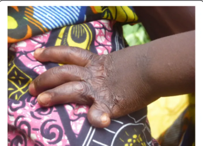 Figure 1 Sequelae of burns: Afissa ’ s left hand, side view (M Egrot, IRD, Nov 2011, Benin).