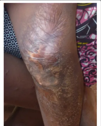 Figure 6 Sequelae of burns: Afissa ’ s left knee (M Egrot, IRD, Nov 2011, Benin).