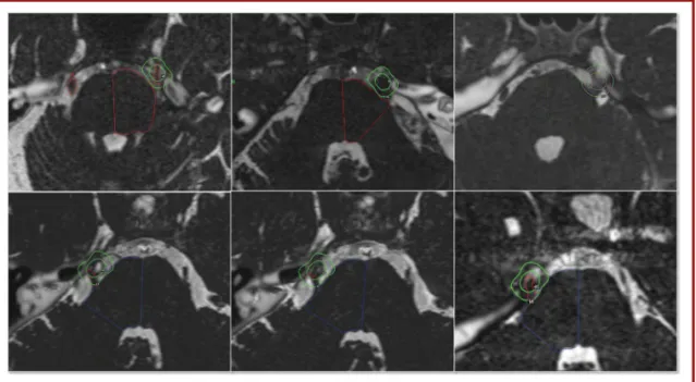 FIGURE 1. Six different examples of targeting in previous microvascular decompression cases.
