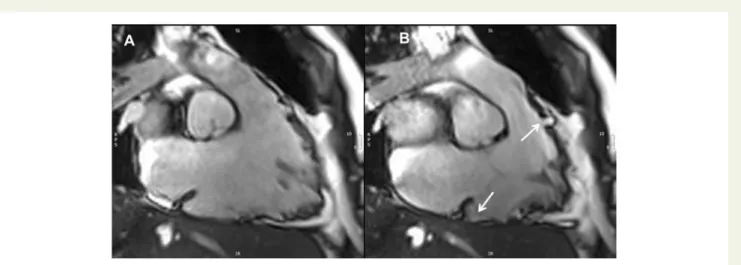Figure 13 CMR four-chamber view, LGE image (A) and corresponding image in cine end-diastolic frame (B)