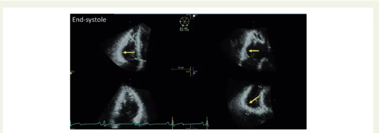 Figure 8 3D TTE images showing the potential of this technique to diagnose AC: multiplanar display of the subtricuspid aneurism
