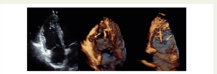 Figure 10 3D TTE images showing the potential of this technique to diagnose AC: localized aneurysm