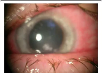 Figure 1 Dolosigranulum pigrum keratitis in patient n1. Central corneal whitish infiltrate at patient ’ s initial presentation.