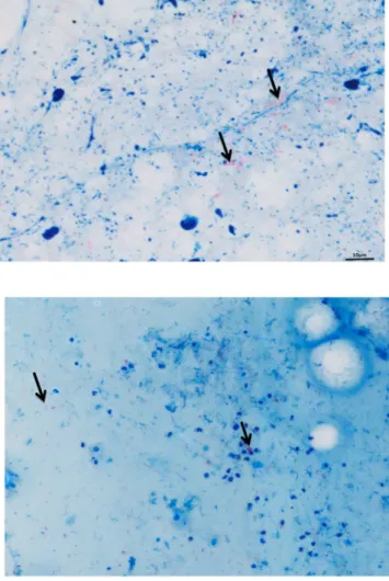 Figure 1. A  M. tuberculosis-positive smear detected positive by standard light microscope (right) and the Zeiss  Axio microscope and software here described (left)