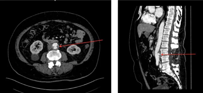 Figure 2. Sagittal sections of 18 F-FDG PET/CT centred on the abdominal aorta. Left: