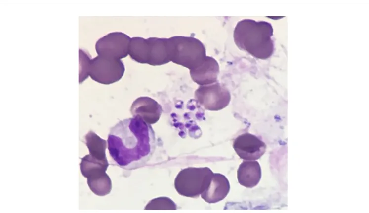 FIGURE 1 | Bone marrow aspirate smear (from bone marrow biopsy) stained with May-Grünwald Giemsa showing amastigote forms of Leishmania spp.