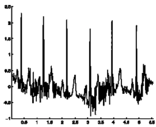 Figure 1 .10 : bruit myoélectriques ou tremblement somatique [18]. 